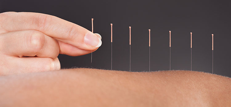 hand placing acupuncture needles into patient back